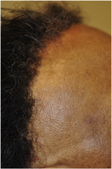 Frontal Fibrosing Alopecia (FFA) scalp