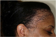 Traction Alopecia scalp