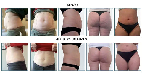 Lipolysis Injections for Sale in South Africa