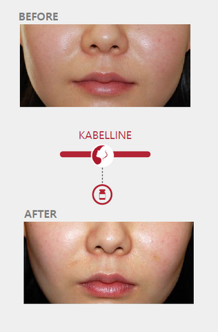 Kabelline Fat Reduction Solution benefits