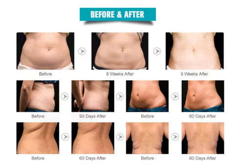 Lipo Laser Machine: 6-in-1 Ultrasonic Cavitation & RF Slimming Before and After