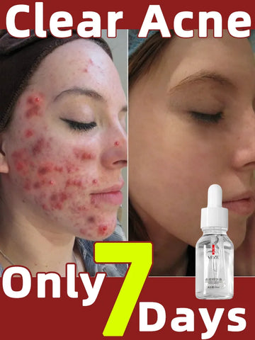 Acne Treatment Serum Korean Skincare Essence. Korean Serum for acne
