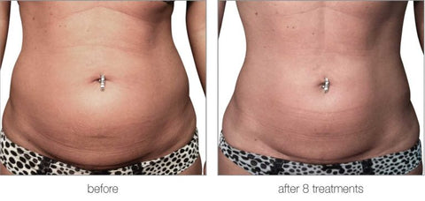 Dr Lipo + Before and after