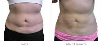 Lipo Lab before and after
