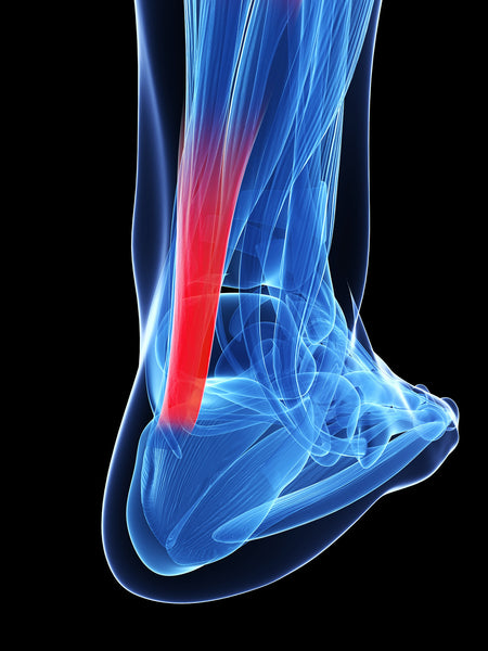 Achilles Tendinitis: Types, Symptoms, Causes, Diagnosis, Treatment, and More