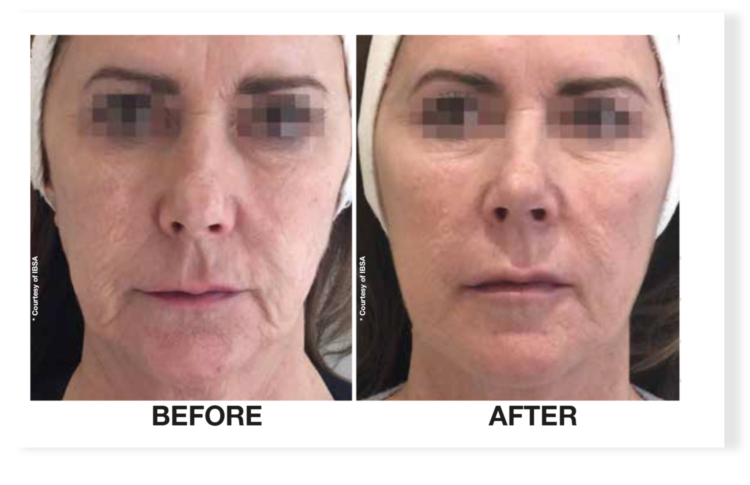 Pulse Light Clinic - Our clients recovery journey with CO2 laser for acne  scar removal ​- ​What is the CO2 Laser? - The CO2 laser is a fractional  treatment for skin rejuvenation