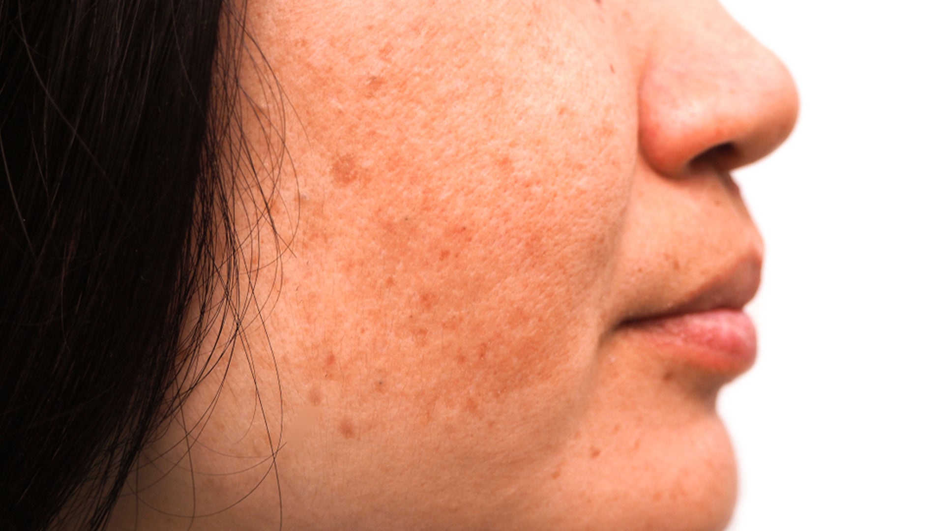 Here Is Everything You Need To Know About Melasma Causes And Treatment Suganda Skincare 9130