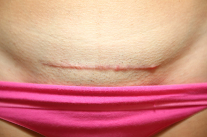cesarean scar after 1 year