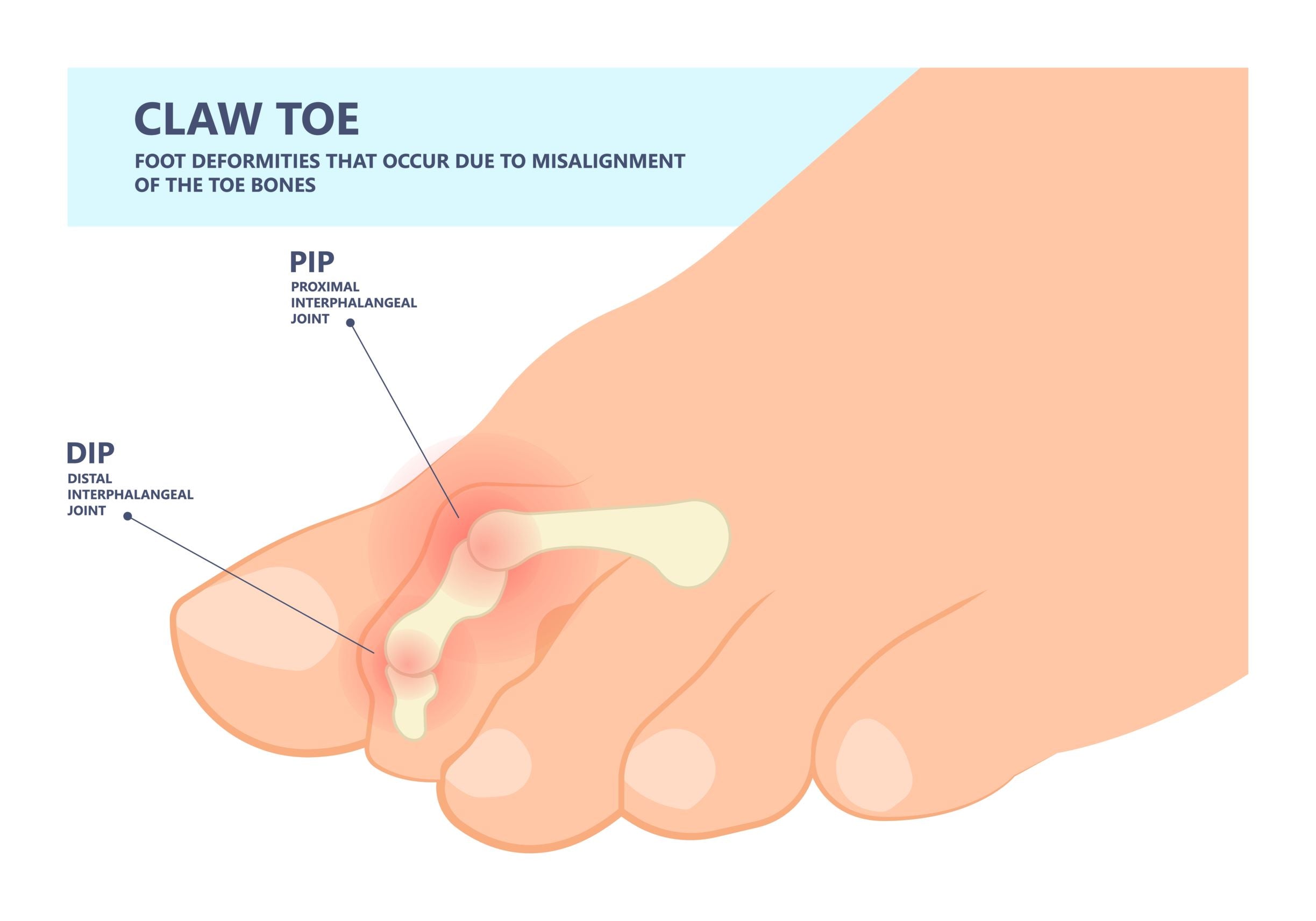 Claw toe diagram