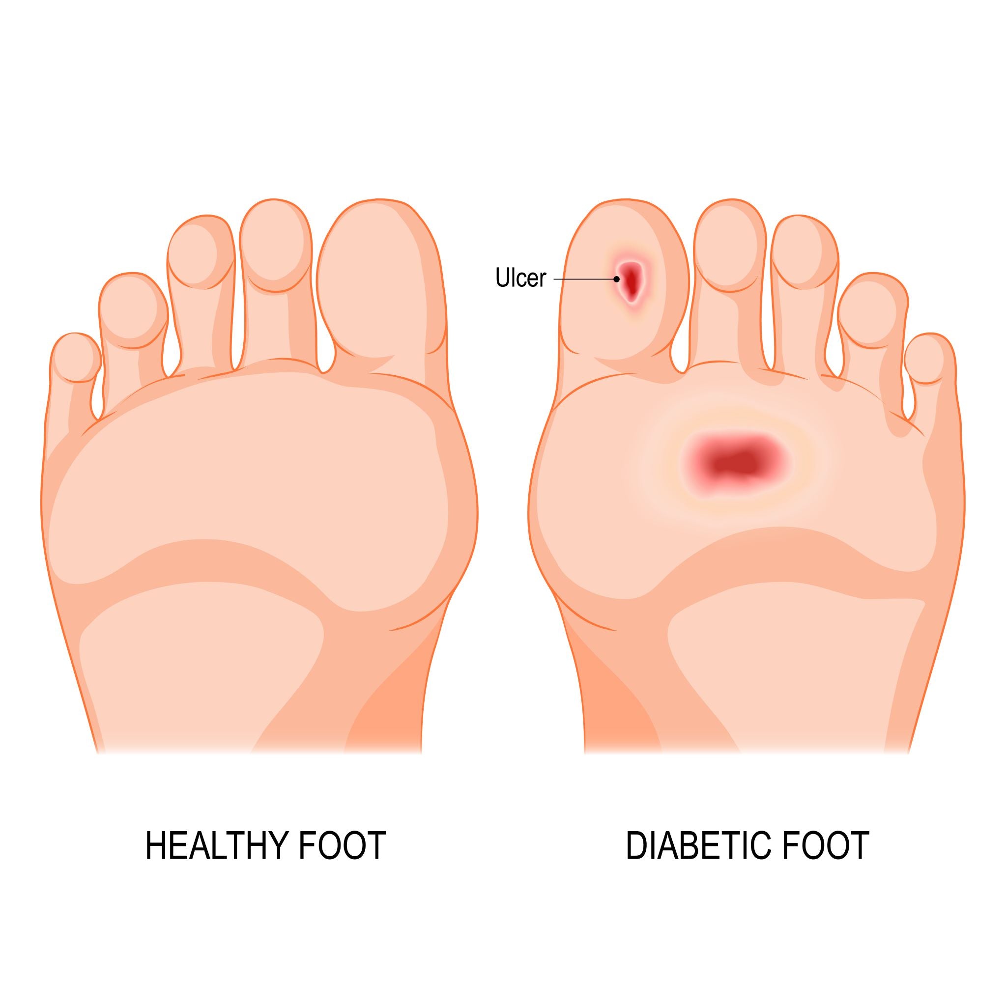 Ulcer diagram