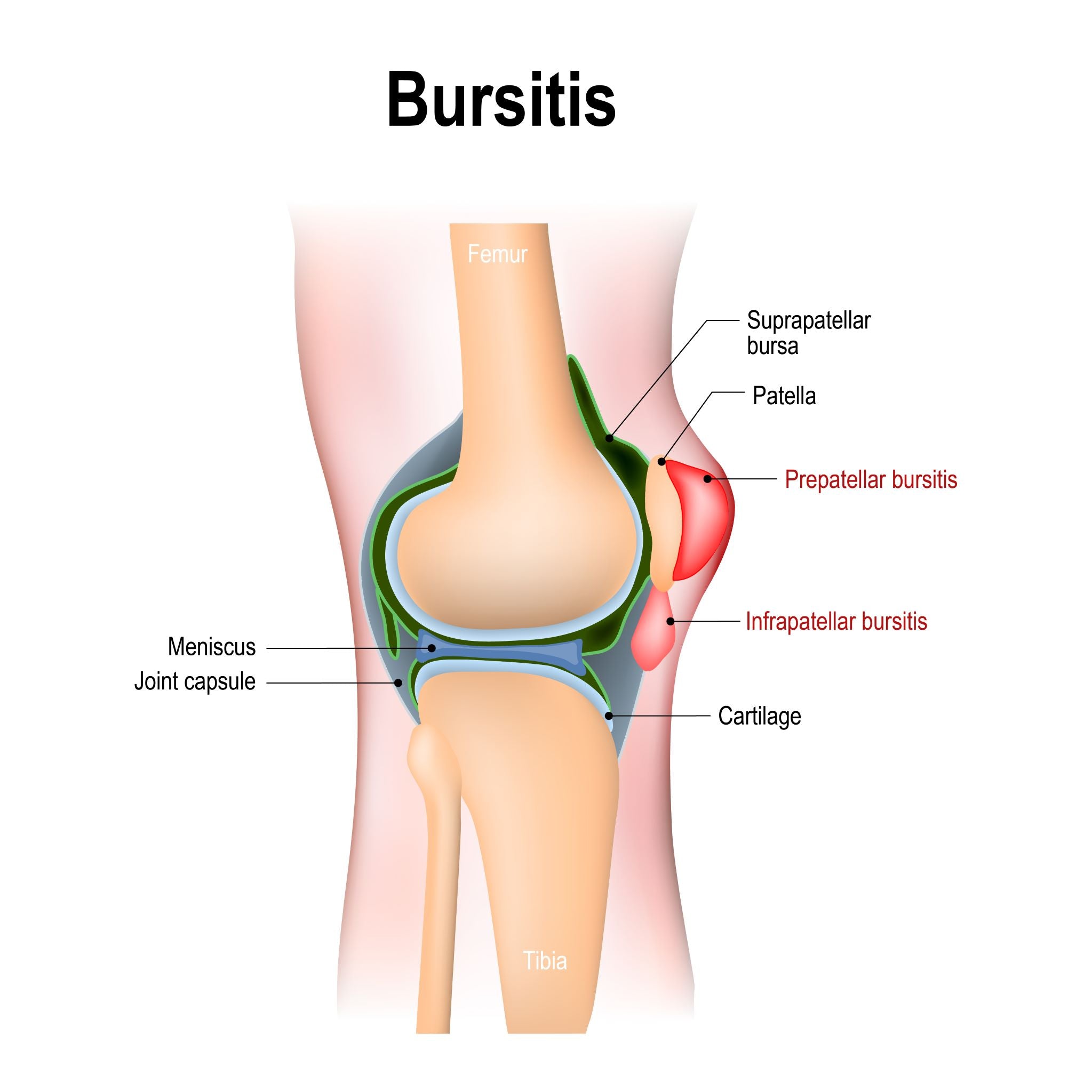 Knee bursitis diagram