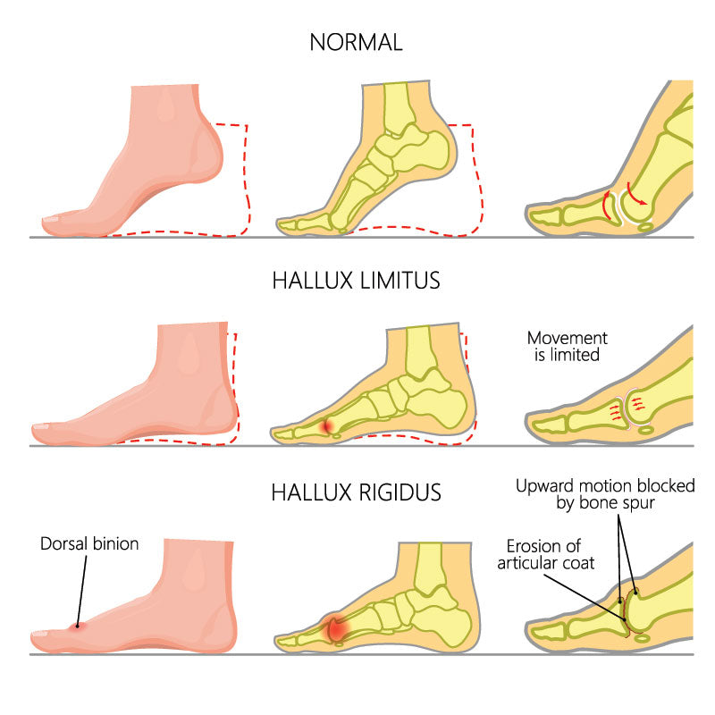 Hallux Rigidus Diagram