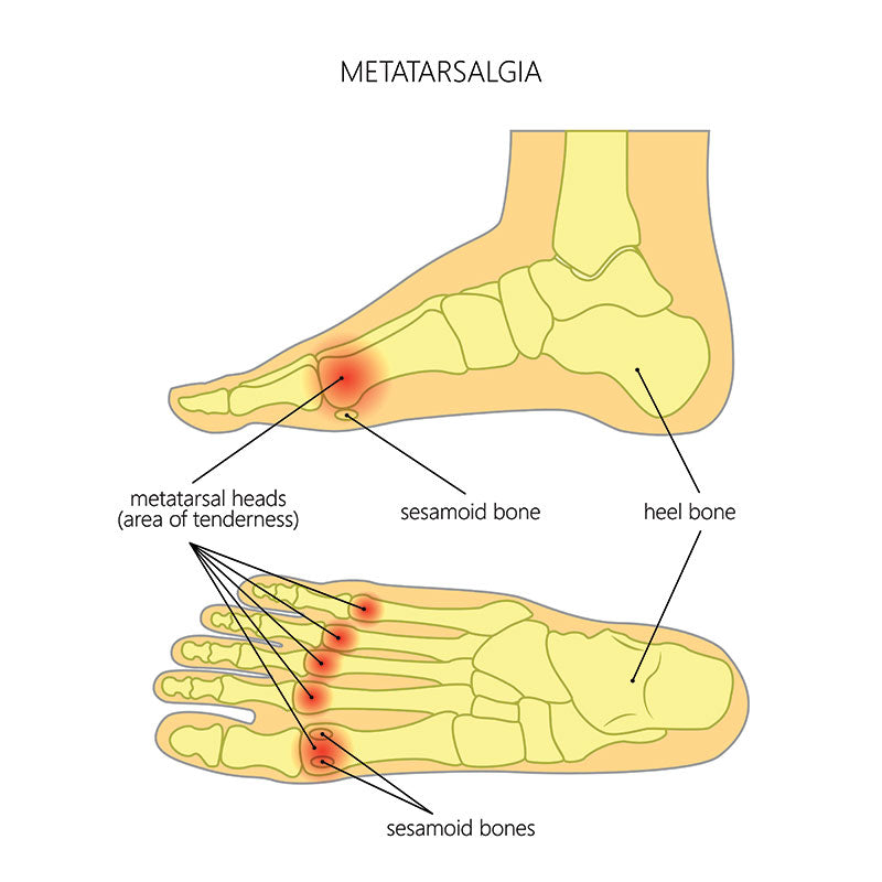 metatarsalgia