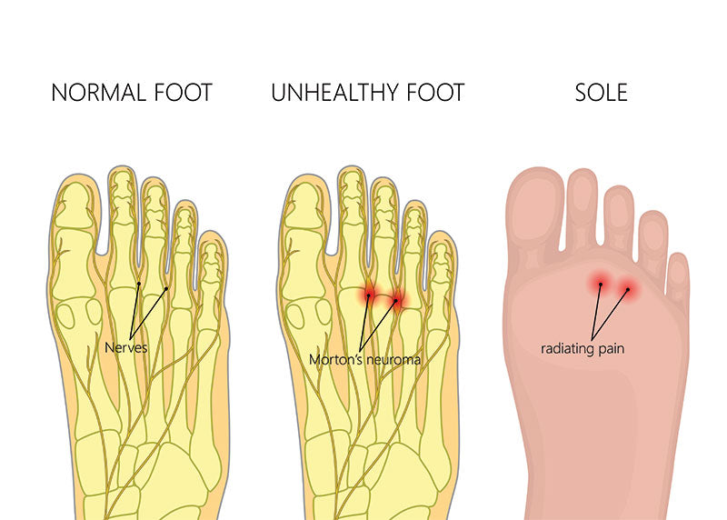 mortons neuroma