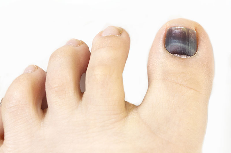 black toenail