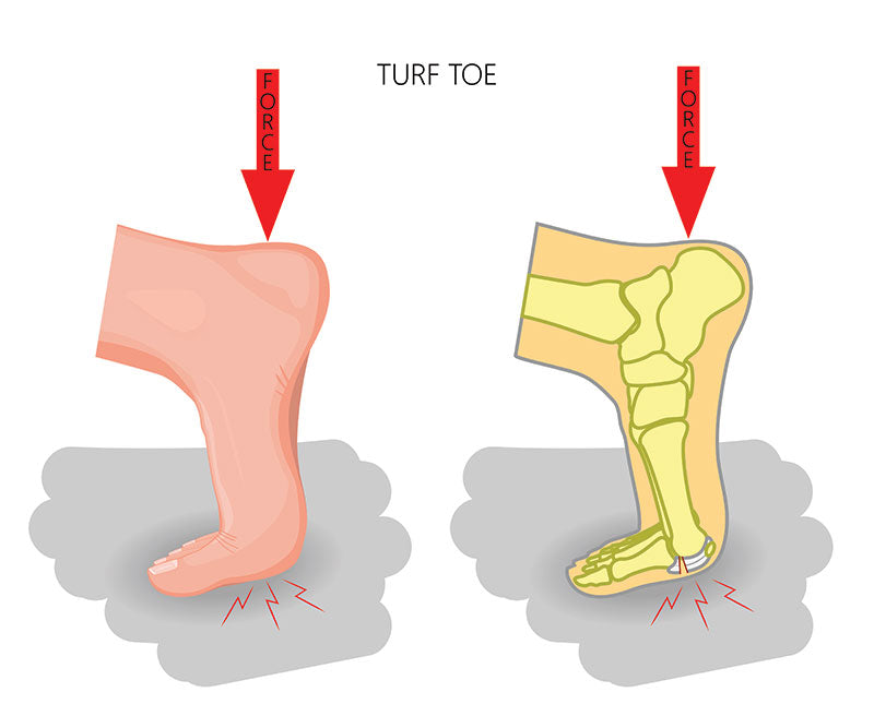 turf toe