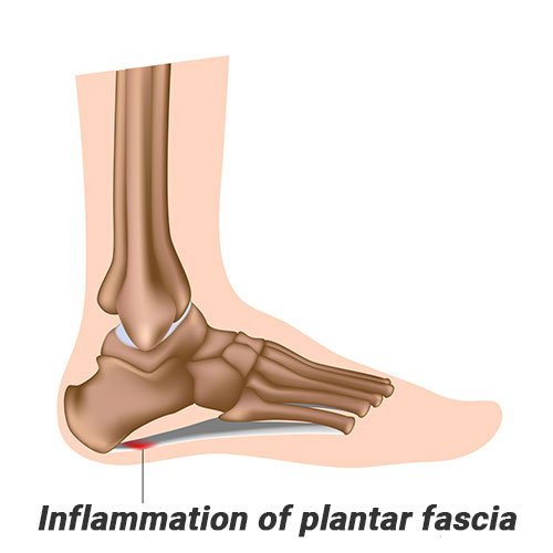 protalus plantar fasciitis