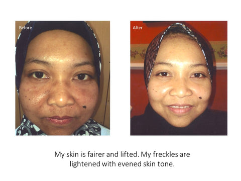 eumora soap testimonial for freckles