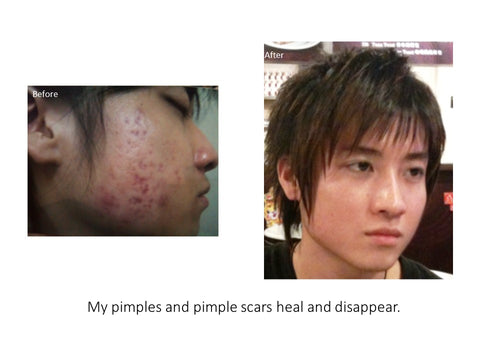 eumora soap testimonial for pimple scars