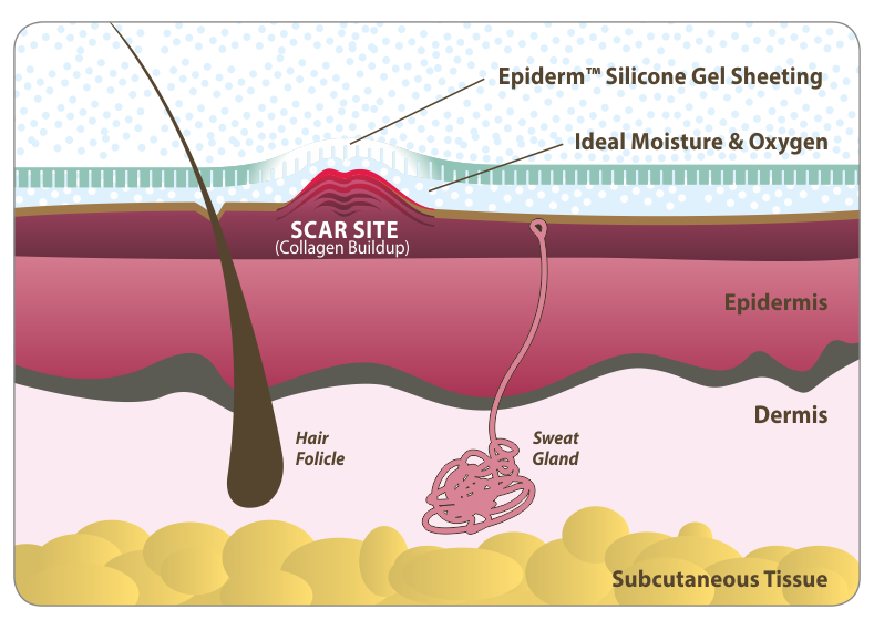 collagen patches for scars