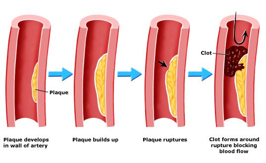 Plaque in Arteries