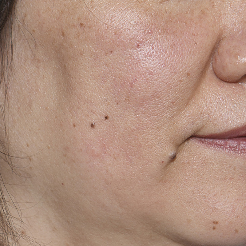 Microdermabrasion ReVit Skin Tightening