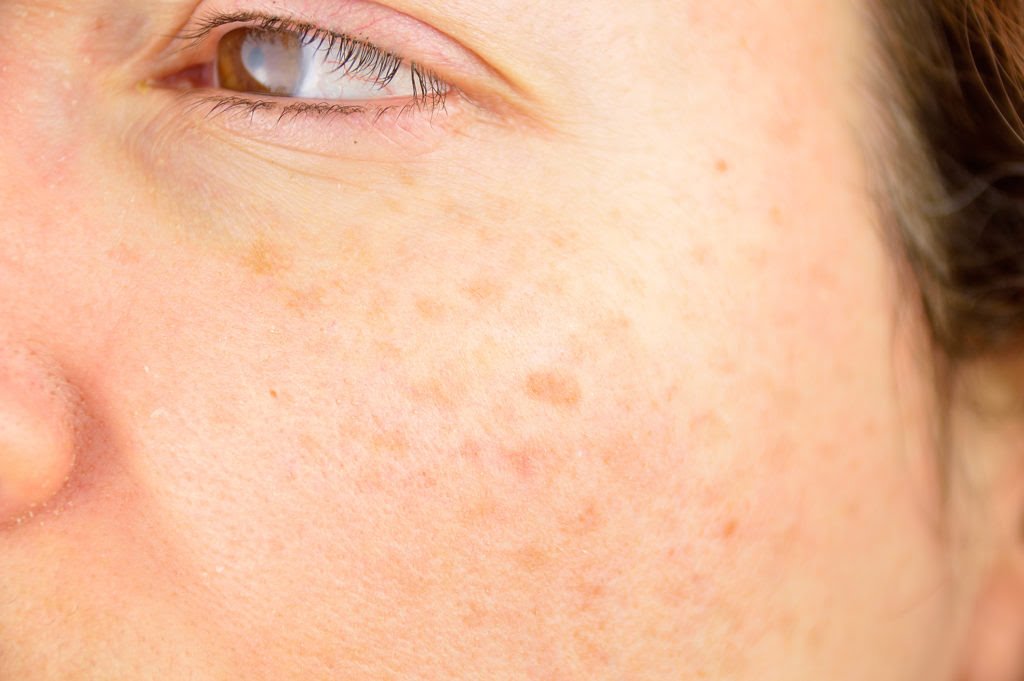 What Do Your Skin Blemishes Say About Your Habits