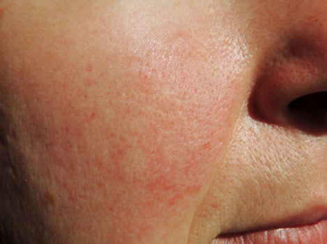 What Do Your Skin Blemishes Say About Your Habits