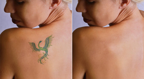 Remove Tattoos Completely And Painlessly