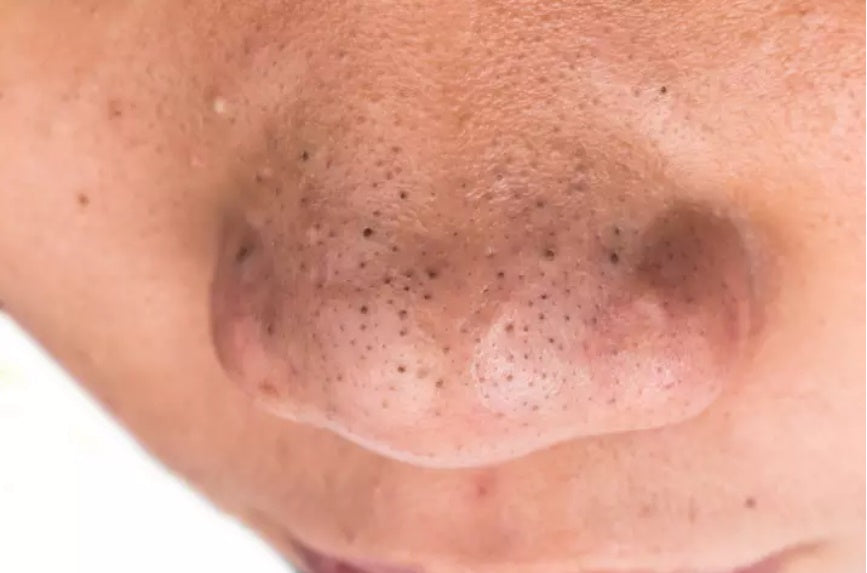 6 Cara Berkesan Hilangkan Blackhead Dihidung Yang Terakhir Paling Muj Yoskin