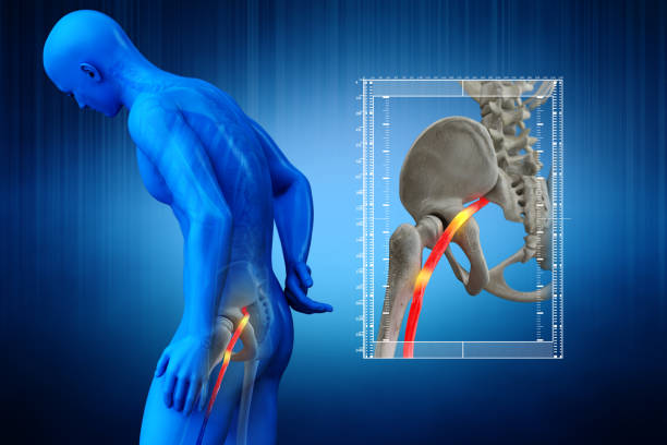 Massage Tutorial: Sciatica myofascial release techniques 