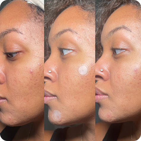 Before & After images of a medium-dark skinned woman using an Early Stage Acne Dot to a blemish on her cheek, showing the blemish go from a red zit with no head to significantly smaller and less red.