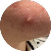 Untreated Mature Ready-to-pop Pimple Blemish