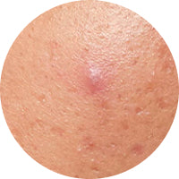 Untreated Early Stage Acne Blemish
