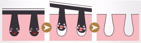 How the Black head remover works