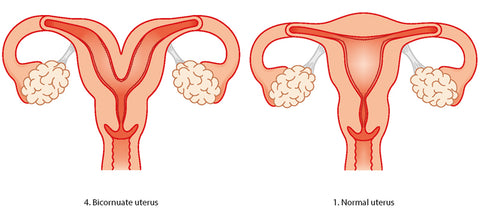 Bicornuate uterus vs normal uterus_ image credit Tommy's.org.uk