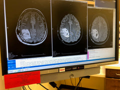 GLIOBLASTOMA HEALING