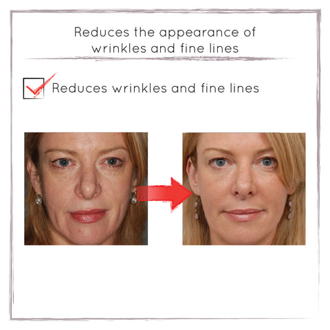 Before and After - Reduced Fine Lines