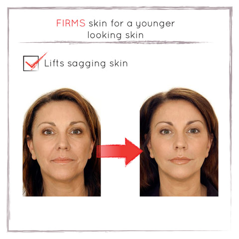 Before and After - Skin Lifting