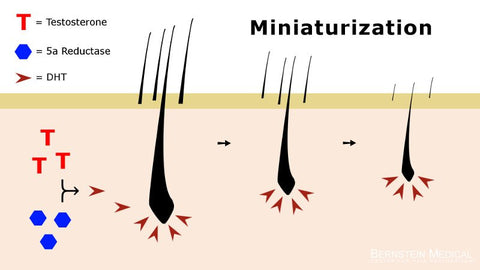 The hormone responsible for hair loss. balding gene. dihydrotestosterone. dht. pattern baldness