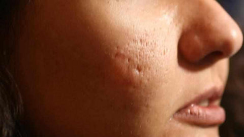 Como quitar las manchas de la cara inmediatamente por granos o acne cicatrices