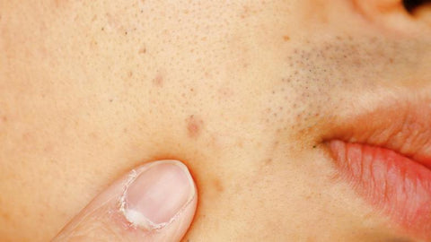 Como quitar las manchas de la cara inmediatamente por granos o acne hiperpigmentación