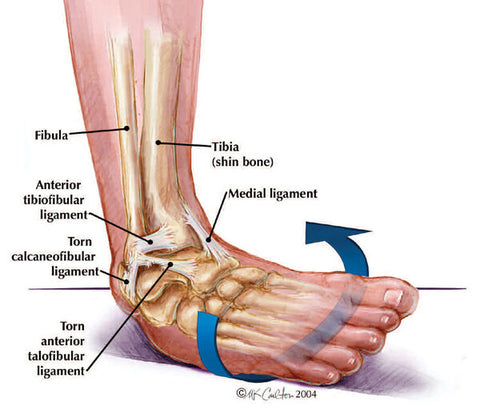 Lesiones comunes de pie y tobillo: esguinces de tobillo.