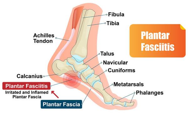 causes of pain in heels plantar fascitis and archilis tendon