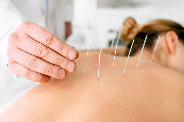 pain management alternatives - acupuncture