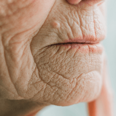 skin fasting causing wrinkles