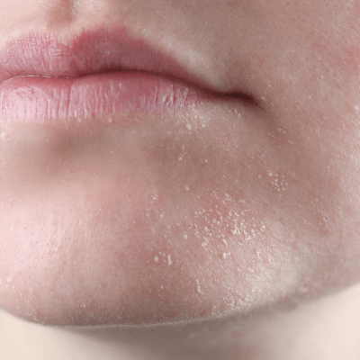 dry skin around chin