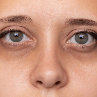 dark circles under eyes