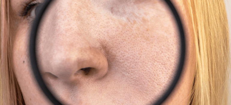 magnifying glass over enlarged pores