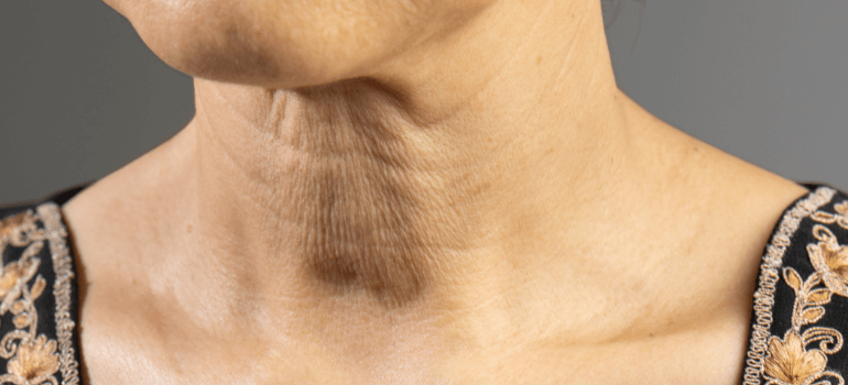 wrinkles on neck skin